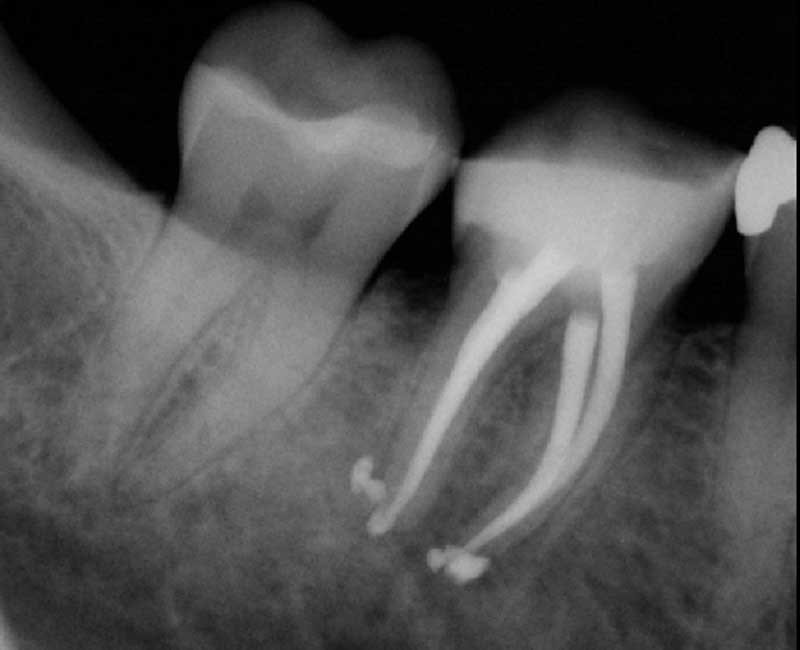 مدیریت عوارض فایل شکسته در کانال دندان