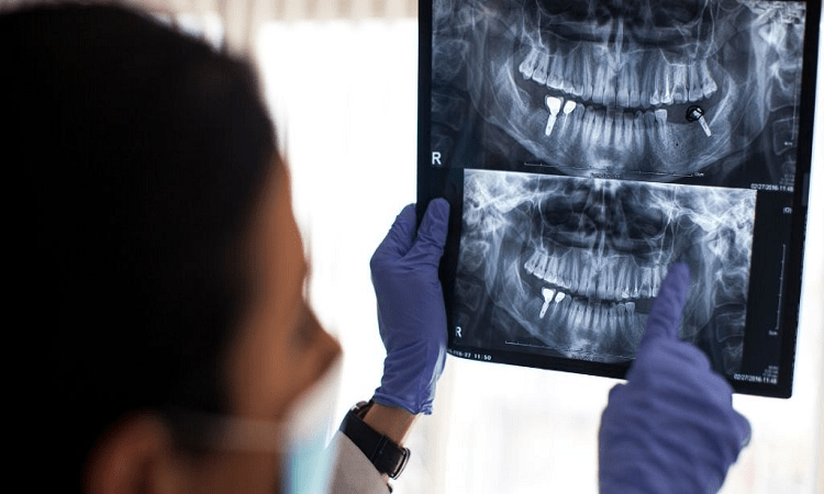 بازسازی استخوان فک برای جراحی ایمپلنت دندان
