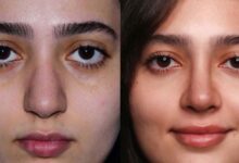 آیا بینی عمل‌شده قابلیت طبیعی شدن دارد؟