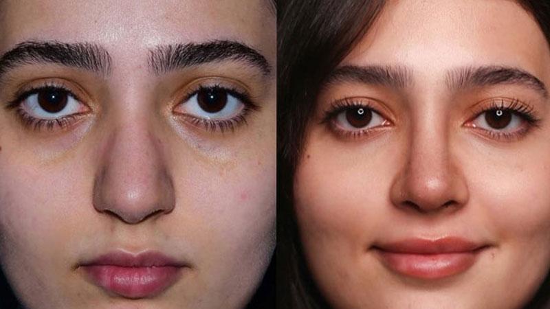 آیا بینی عمل‌شده قابلیت طبیعی شدن دارد؟