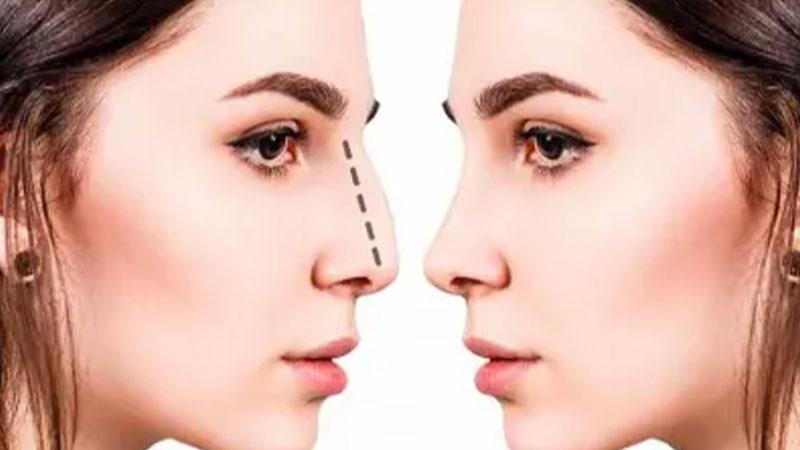 بهترین زمان برای عمل بینی طبیعی